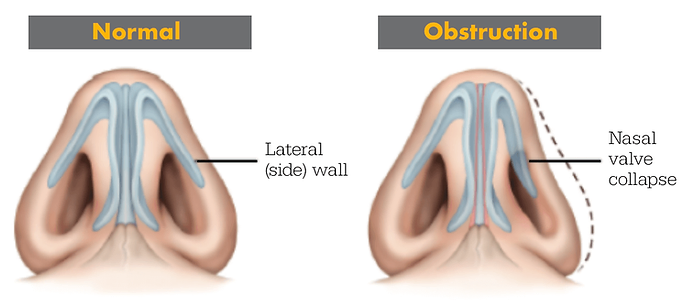 How Do Nasal Strips Work?